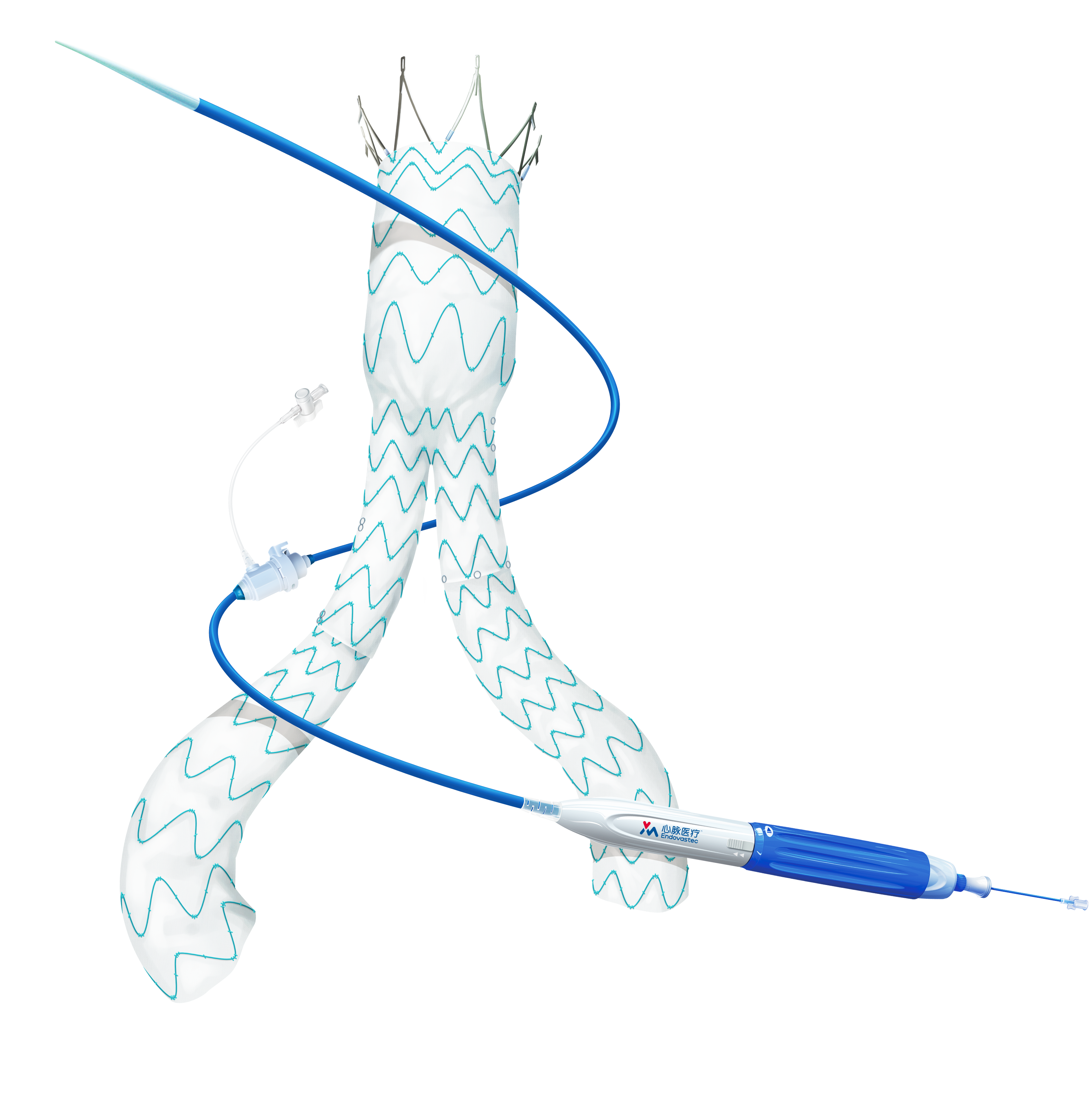 Minos®/定海塔™腹主动脉覆膜支架及输送系统